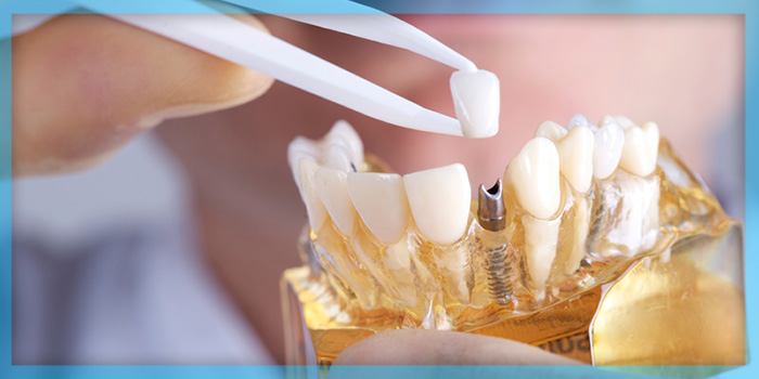 Dental implants,ایمپلنت دندان